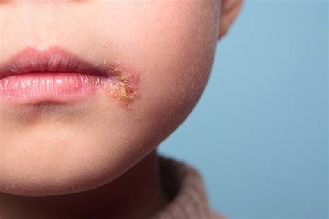 Impetigo In Children What Are Its Symptoms And How To Deal With It