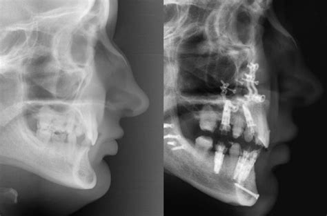 Deep Bite Correction Mandibular Maxillary Advancement Corrective Jaw