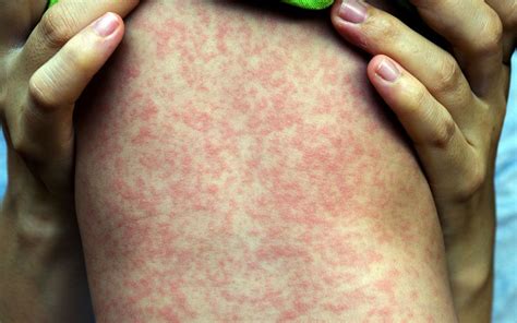 This One Number Shows Why Measles Spreads Like Wildfire Live Science