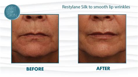 Restylane Silk To Lower Lip Wrinkles San Diego Youtube