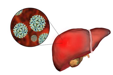 Hepatic Steatosis Associated With Lower Risks In Chronic Hepatitis B