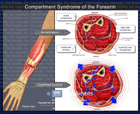 Compartment Syndrome Of The Forearm Trial Exhibits Inc