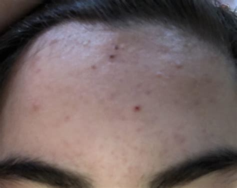 Acne Im Prone To Acne In My Hairline And I Dont Know What To Do