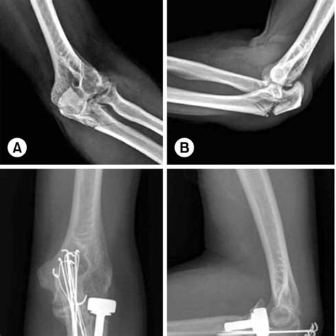 Pdf The Short Term Results Of Radial Head Arthroplasty With Unipolar