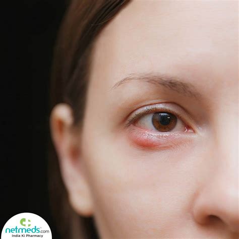 Stye Causes Symptoms And Treatment