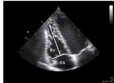 333 Visual Assessment Of Right Ventricular Function 123 Sonography