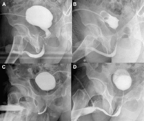 Serial Retrograde Urethrograms In A Man Aged Years A Posterior
