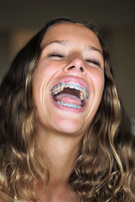 Pin By John Beeson On Girls In Braces In 2021 Braces Girls Perfect Teeth Teeth