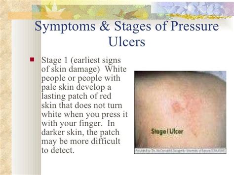 Pressure Ulcer Prevention And Skin Care