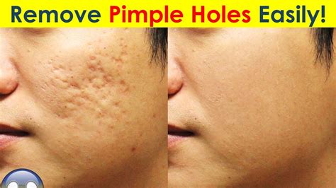 3 Ways To Remove Pimple Holes Acne Scars And Pimple Marks Fast Youtube