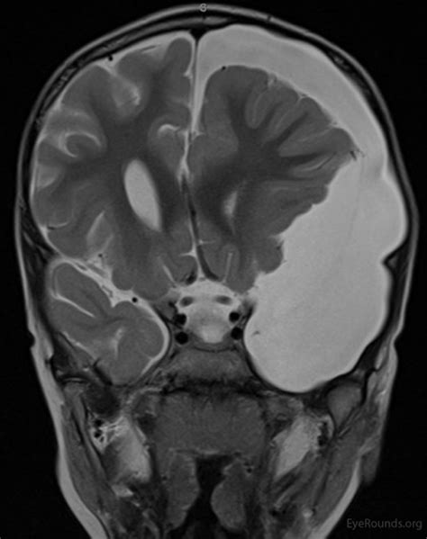 Atlas Entry Bilateral Cranial Nerve Vi Palsies Secondary To Arachnoid