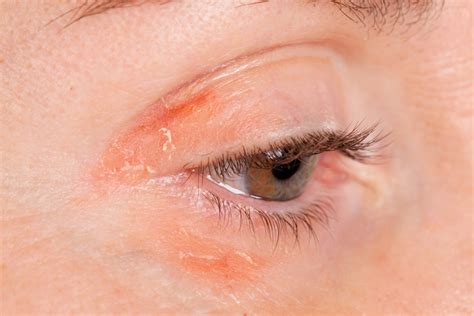 8 Tips For Dealing With Psoriasis On Your Eyelids The Healthy