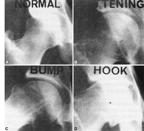 Ad Ap Radiographs Of A A Normal Hip And Three Forms Of Abnormalities
