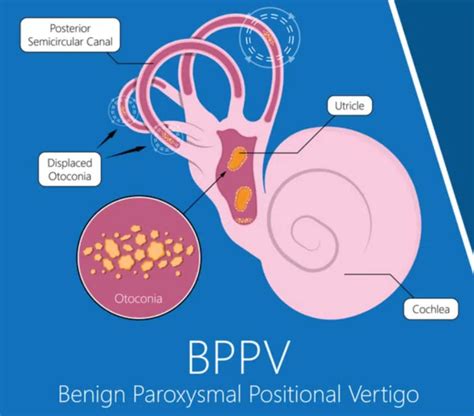Benign Paroxysmal Positional Vertigo A Case Study Physiopedia