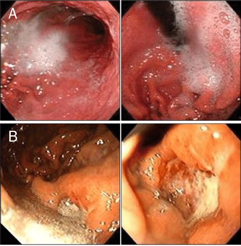 Endoscopic Finding Of Misdiagnosed Advanced Gastric Cancer Of The Upper Download Scientific