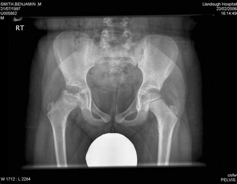 Perthes Disease Cardiff Hip Replacement