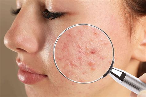 Best Skincare Ingredients To Look For If You Have Acne Sl Aesthetic Clinic
