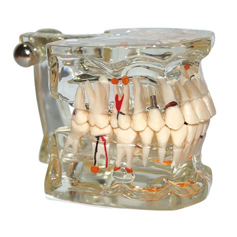 Dental Model Teeth Pathology Model With Half Implant Show Clearly The