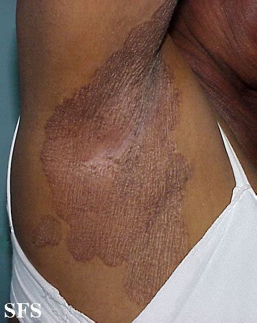Speak with your doctor if you are really concerned, no matter. Armpit Rash (Red, Dark, Itchy, Painful Bumps): Causes ...