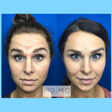Forehead Botox Before And After Mgmd Aesthetics