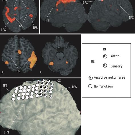 Bold Signal Activation Of Functional Mri Fmri During A Motor Task And