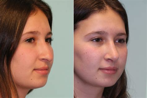 Rhinoplasty Photos Chevy Chase Md Patient 19667