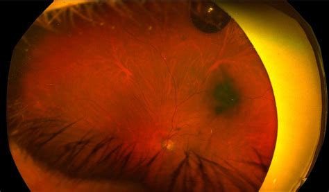 Flashes And Floaters Macula Retina Vitreous Center