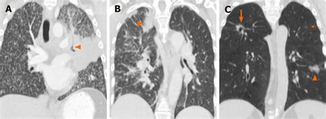 Role Of Imaging Biomarkers In Mutation Driven Non Small Cell Lung Cancer