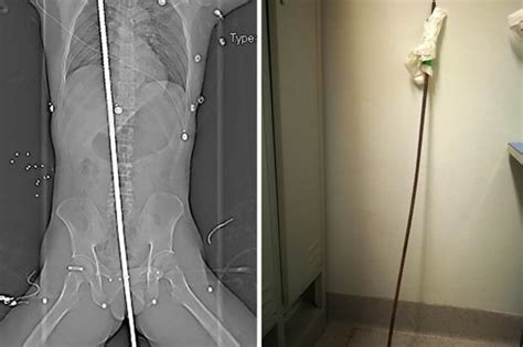 Workman Electrocuted Then Impaled Through Backside By 4ft Steel Bar