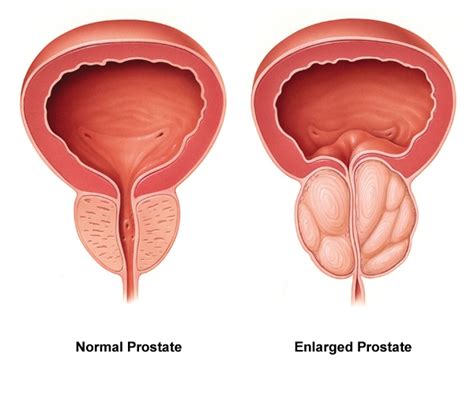 Enlarged Prostate Bph Urology Center Of Iowa