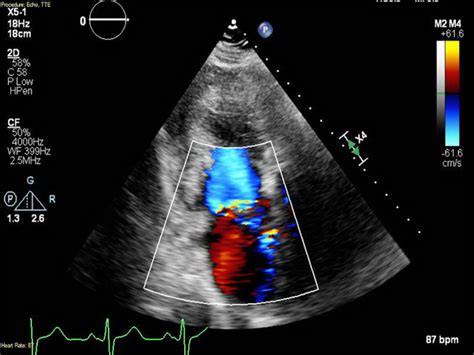 Cureus Infective Endocarditis Involving Mitral And Aortic Valves With