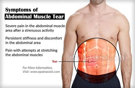 Abdominal Muscle Tear Causes Symptoms Treatment Recovery Exercise