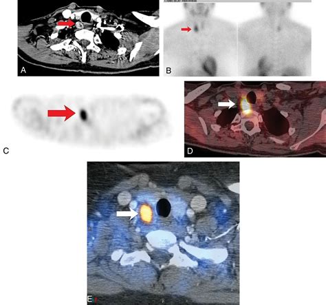 Solitary Parathyroid Adenoma Localization In Technetium Tc99m Sestamibi