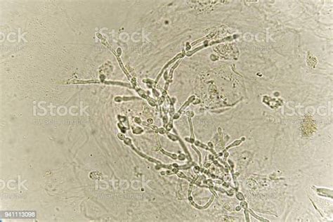Pseudohyphae And Budding Yeast Cells In Urine Stock Photo Download