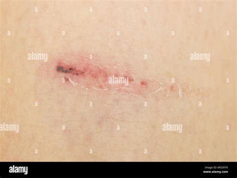 Bruised Skin Hi Res Stock Photography And Images Alamy