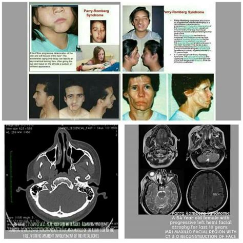perry romberg syndrome parry romberg syndrome also known as progressive hemifacial atrophy is
