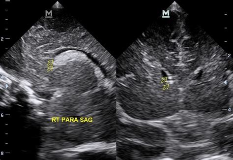 Grade 1 Germinal Matrix Hemorrhage Image