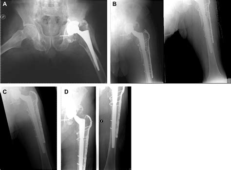 Periprosthetic Hip Fractures With A Loose Stem Open Reduction And