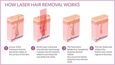 Hair removal creams have come a long way. how Laser hair removal works | Chiltern Medical Clinics