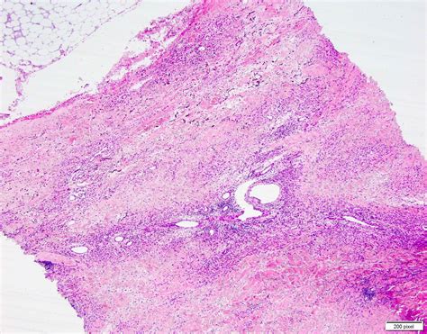 Pathology Outlines Calciphylaxis