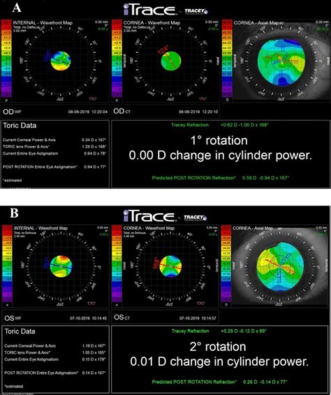 Itrace Showing Rotational Stability At Months Post Op A Eyecryl Download Scientific
