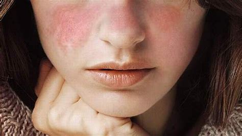 Lupus Causes Symptoms Diagnosis And Treatment