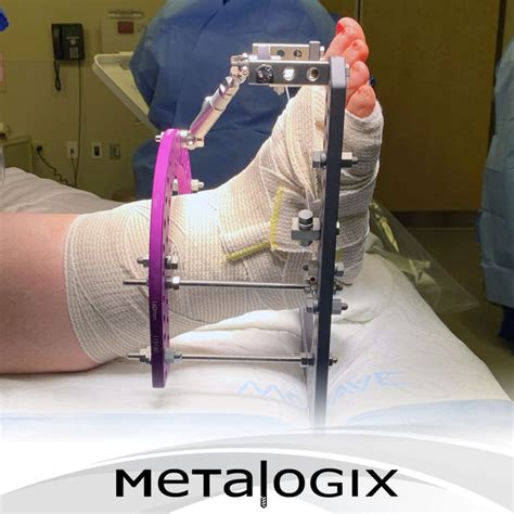 Ankle Distraction Metalogix