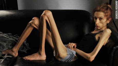 Anorexic Woman S Dramatic Transformation Cnn Video
