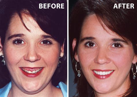 While crowns are known for covering teeth, they are great for disguising and protecting the small teeth in question. Gummy Smiles - What Causes A Gummy Smile?