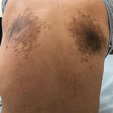 Well Defined Bilateral Hyperpigmentation With Irregular Borders On The