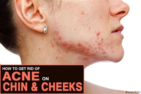 How To Get Rid Of Acne On Cheeks And Chin Naturally Moisturizer For