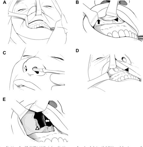 A practical approach to extensive sive bilateral benign tumors of the nasal cavity and paranasal sinuses. A modified midfacial degloving approach for the treatment ...