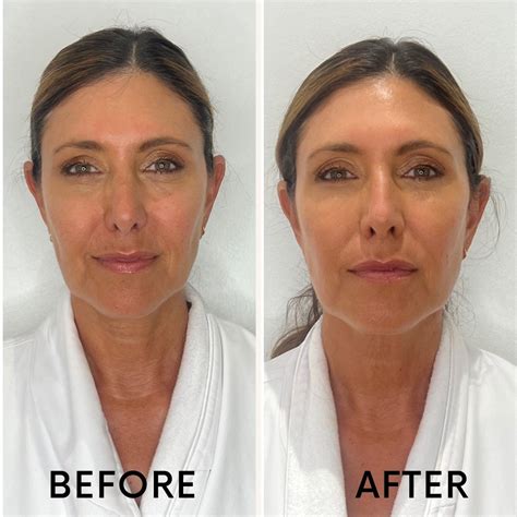 The Best Non Invasive Treatment For Skin Tightening — The Glow Girl By