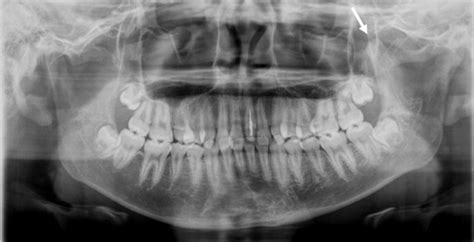 Panoramic Radiographic Image Showing Normal Morphology Of The Left